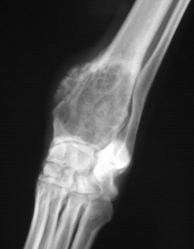 osteosarcoma